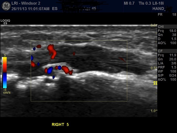 Figure 4 for case Malignant myoepithelial tumour of soft tissue